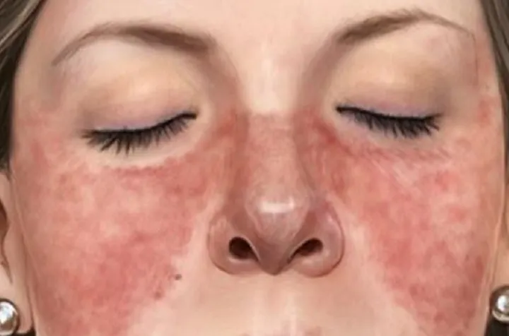 بیماری خودایمنی لوپوس و ارتباط آن با استرس