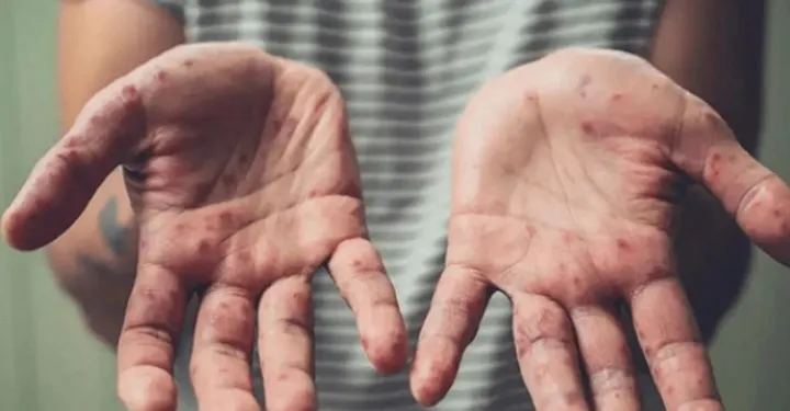 ادعای مقامات وزارت بهداشت جمهوری اسلامی: آبله میمون از کانادا به ایران منتقل شده است